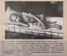 Photo en noir et blanc d'un homme famélique recroquevillé sur un lit.