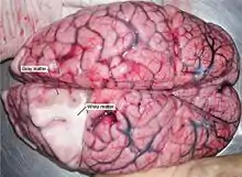 Dissection d'un cerveau démarquant la substance blanche de la matière grise.