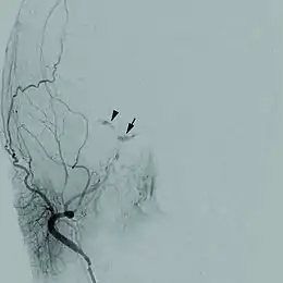 Description de l'image 1471-2415-12-28-1Cerebral angiogram.jpg.