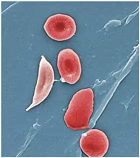 Érythrocytes falciformes et codocytes parmi des globules rouges normaux