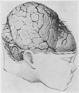 Déformation du cerveau chez un enfant à terme mort-né. Pr P.Schwartz : birth injury of the newborn. 1961.