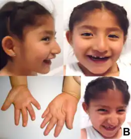 Description de l'image 5-year-old Mexican girl with Angelman syndrome (cropped).png.