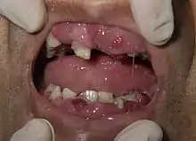 hypertrophie gingivale