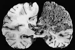 Importante malformation artério-veineuse dans la région du cerveau, le tissu a été majoritairement remplacé par le conglomérat vasculaire pathologique.