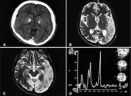 Description de l'image A computed tomography brain scan showing bilateral basal ganglia calcification.jpg.