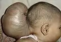 Nouveau-né avec encéphalocèle