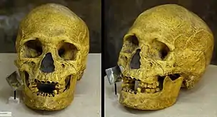 Photo d'un crâne, pris de face et de trois-quart face.