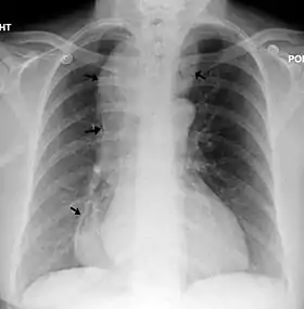 Radiographie pulmonaire d'un individu atteint d'achalasie