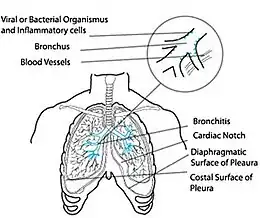 Description de l'image Acute-bronchitis.jpg.