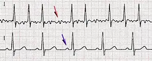 Afib ecg