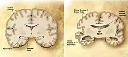 Comparaison d'un cerveau normal à droite et d'un cerveau atteint de la Maladie d'Alzheimer  à gauche.