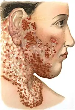 Description de l'image An introduction to dermatology (1905) Lupus vulgaris 2.jpg.