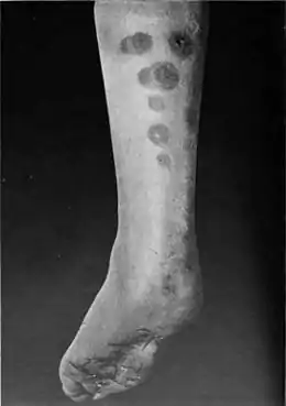 Description de l'image An introduction to dermatology (1905) erythema induratum 2.jpg.