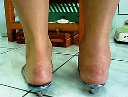 Description de l'image Ankle Joint Arthritis.jpg.