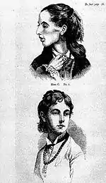 Croquis ou gravure représentant une jeune adolescente atteinte d'anorexie mentale avant et après. Dessins esquissés en 1874, par Sir William Whitey Gull.