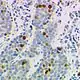 Photographie couleur de cellules de microscope avec une coloration bleue et des cellules marrons qui ont réagi à un produit par immunomarquage
