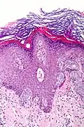 Cellules de carcinome.