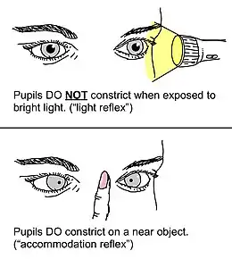 Description de l'image Argyll Robertson pupil light reflex vs accommodation reflex.jpg.