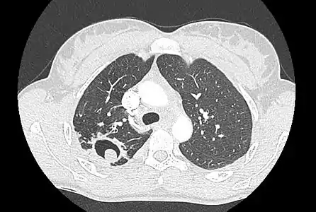 Cavité dans le poumon au sein duquel s'est développé un aspergillome simple.