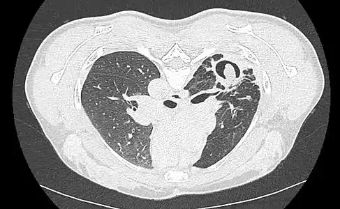 Cavité dans le poumon au sein duquel s'est développé un aspergillome.