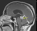 Astrocytome de bas grade dans le mésencéphale (flèche) en séquence T1 à l'IRM, vue sagittale