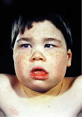 Enfant de huit ans avec les caractéristiques faciales de la maladie