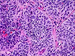 Description de l'image Atypical carcinoid tumor of lung metastatic to the adrenal gland Case 255 (8268009504).jpg.