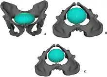 Reconstitution de la naissance d'un nouveau-né (en bleu) dans le bassin d'un Australopithecus sediba, vue sous plusieurs angles.