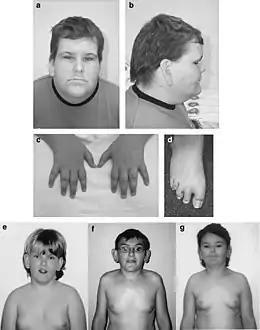 Description de l'image Börjeson-Forssman-Lehmann syndrome in males.jpg.