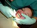 Préparation des dents d'un patient afin d'y appliquer des broches.