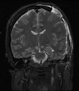 Description de l'image Brain herniation MRI.jpg.