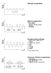 (en) Respiration de Kusmaul