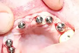 Implants en place. Notez qu'il y a moins d'implants que de dents sur la prothèse.