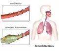 Comparaison entre bronche saine et bronche dilatée.