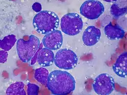 Cellules de lymphome.