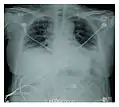 Radiographie montrant une réduction marquée de la capacité pulmonaire