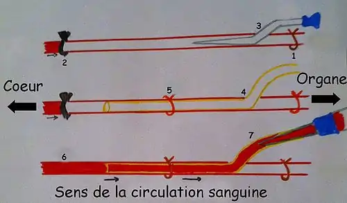 Schéma d'une canulation artérielle