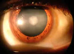 Cataracte sur un œil humain — vue grossie de l'examen à la lampe à fente. La chirurgie de la cataracte était pratiquée par Sushruta. En Inde, la chirurgie de la cataracte était réalisée avec un instrument spécial appelé Jabamukhi Salaka, une aiguille courbe utilisée pour abaisser le cristallin et repousser la cataracte en dehors du champ de vision. L'œil est ensuite enduit de beurre chaud et recouvert d’un pansement.