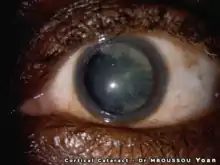 Vue d'une cataracte corticale à l'examen de lampe à fente
