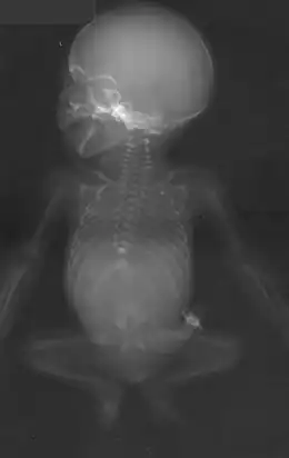 Description de l'image Caudal regression syndrome radiograph.jpg.