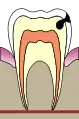 3. La dentine est attaquée. La dent commence à être sensible.