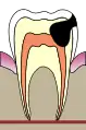 4. La carie gagne la pulpe dentaire : pulpite  (la classique rage de dent)