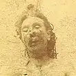 Photographie mortuaire en noir et blanc d'une femme dont la partie basse du visage est sévèrement mutilé.