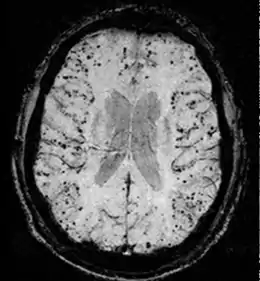Description de l'image Cerebral amyloid angiopathy (CAA)-MRI.png.