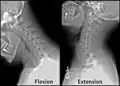 Radiographie de la colonne cervicale en flexion et en extension.