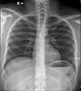 Rayon X des poumons humains