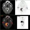 Métastases ostéolytiques dans la deuxième vertèbre du cou  (Axis) d'un cancer de la prostate.