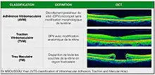 Classification des trous maculaires ( IVTS 2013)