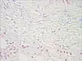 Biopsie de muscle montrant une bactérie Gram-positive, anaérobie formant des endospores dans le muscle infecté, très compatible avec une infection à Clostridium perfringens.