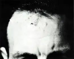 Description de l'image Coccidioidomycosis granulomas on forehead.png.